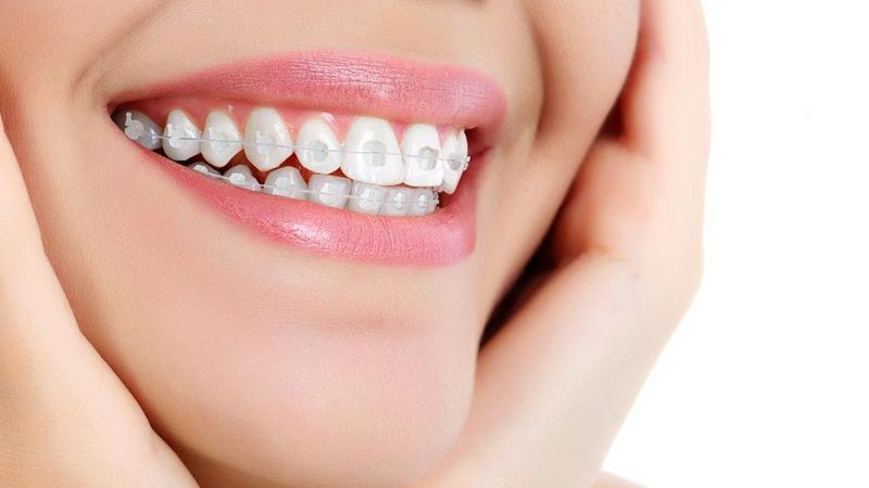 Giá niềng răng hô bao nhiêu tiền? Yếu tố quyết định mức giá Niềng răng mắc cài pha lê có chi phí ở tầm trung