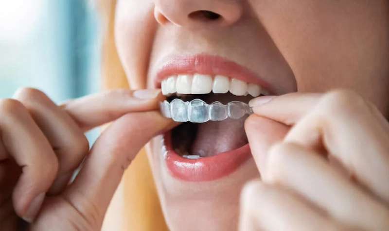 Giá niềng răng Nha Trang bao nhiêu? Mức phí tại 5 nha khoa Giá niềng răng Nha Trang nhìn chung “dễ chịu” hơn Hà Nội, TP Hồ Chí Minh