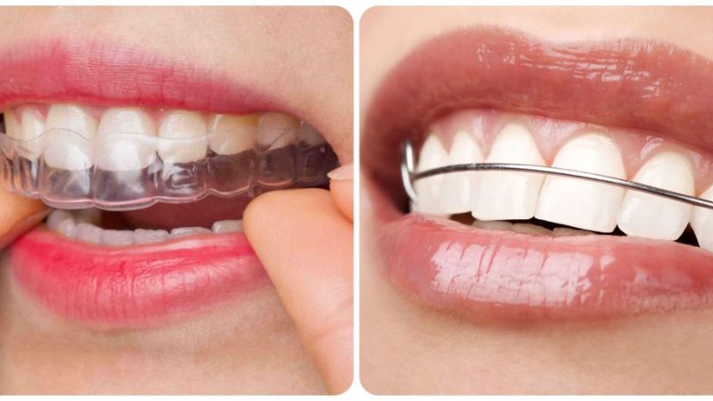 Hàm duy trì sau niềng răng giá bao nhiêu? 4 yếu tố ảnh hưởng Bạn nên đeo hàm duy trì trong thời gian 1 - 2 năm