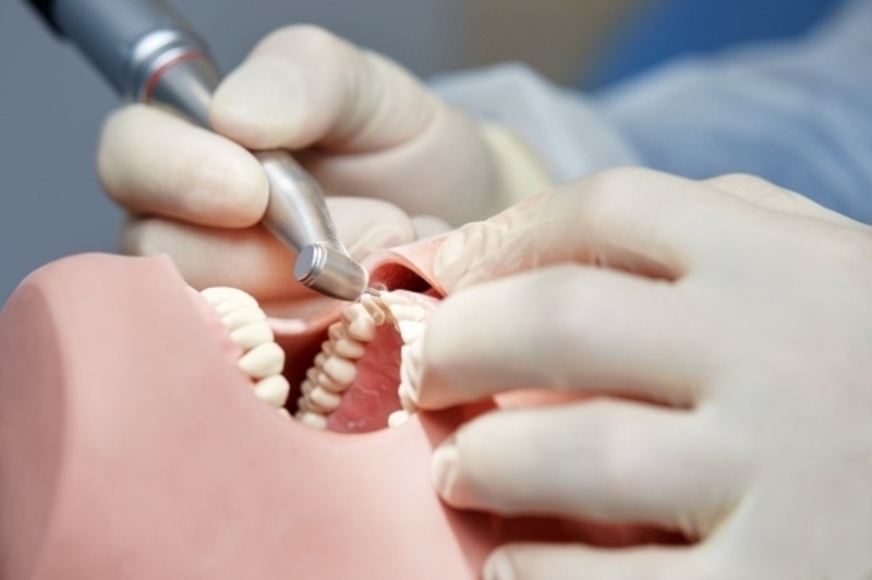 Giải đáp nhanh: Mài răng bọc sứ có ảnh hưởng gì không Mài răng bọc sứ đúng kỹ thuật không gây hại tủy răng