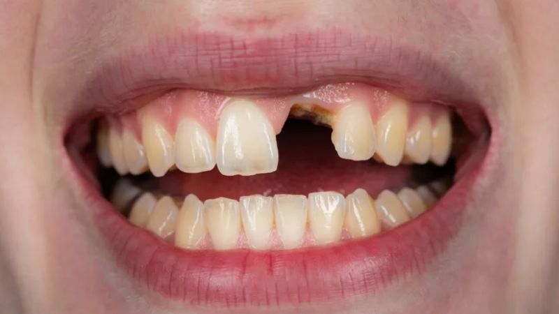 Mất răng có bọc sứ được không? Giải pháp khôi phục phù hợp mất răng có bọc sứ được không? Khi không còn trụ răng, mất răng không thể bọc sứ