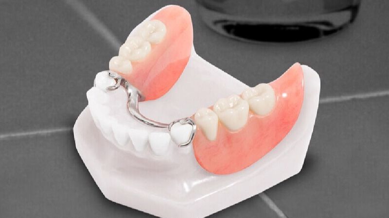 Mất răng có bọc sứ được không? Giải pháp khôi phục phù hợp Sử dụng răng tháo lắp là giải pháp thay thế phù hợp