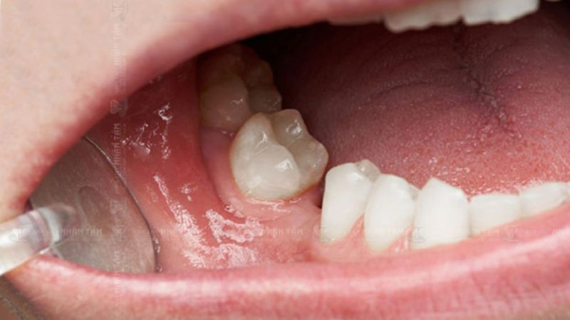 Mất răng có bọc sứ được không? Giải pháp khôi phục phù hợp Đối với người mất răng lâu năm thì trồng răng Implant vẫn là giải pháp tối ưu