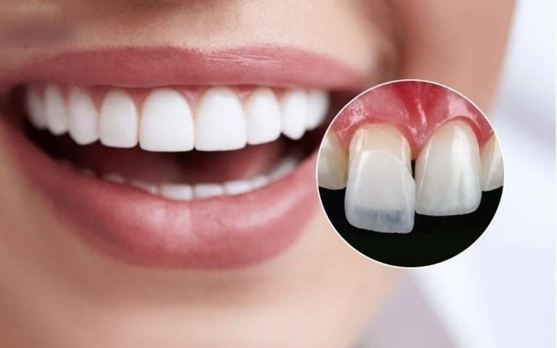 Nên bọc răng sứ hay dán veneer? Lời khuyên từ nha sĩ Thăm khám nha khoa để quyết định bọc răng sứ hay dán veneer