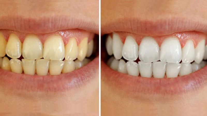 Nên tẩy trắng răng hay bọc sứ? Lời khuyên từ bác sĩ nha khoa Nên tẩy trắng răng hay bọc sứ? Tẩy trắng răng nên được thực hiện với trường hợp răng vàng nhẹ, men còn tốt