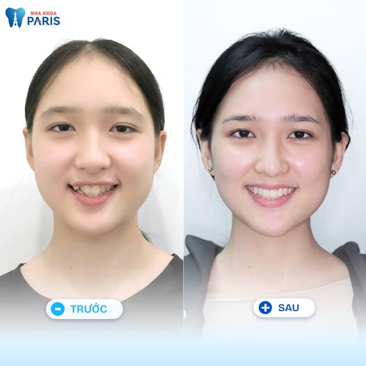 Nha khoa Paris: Nha khoa tiêu chuẩn Pháp uy tín hàng đầu Việt Nam Chi phí tại Nha khoa Paris cao hơn mặt bằng chung nhưng chất lương tương xứng giá tiền