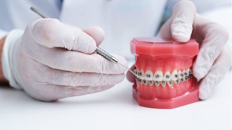 Nhổ răng để niềng có nguy hiểm không? Trường hợp nào an toàn Trường hợp nhổ răng để niềng là an toàn khi thực hiện ở cơ sở nha khoa uy tín