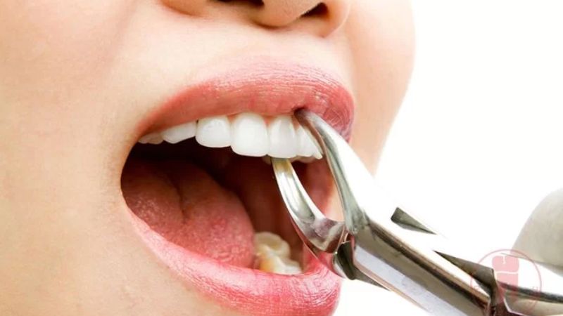 Nhổ răng để niềng có nguy hiểm không? Trường hợp nào an toàn Bạn chỉ nên nhổ răng để niềng khi có sự chỉ định từ bác sĩ