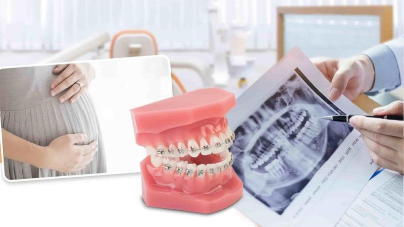 Niềng răng có ảnh hưởng đến thai nhi không? Lưu ý an toàn Niềng răng không ảnh hưởng đến thai nhi và mẹ bầu