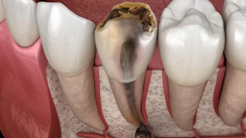 Niềng răng có ảnh hưởng gì không? Giải đáp chi tiết từ bác sĩ Chết tủy hay tiêu xương ổ răng là những ảnh hưởng khi niềng răng sai cách