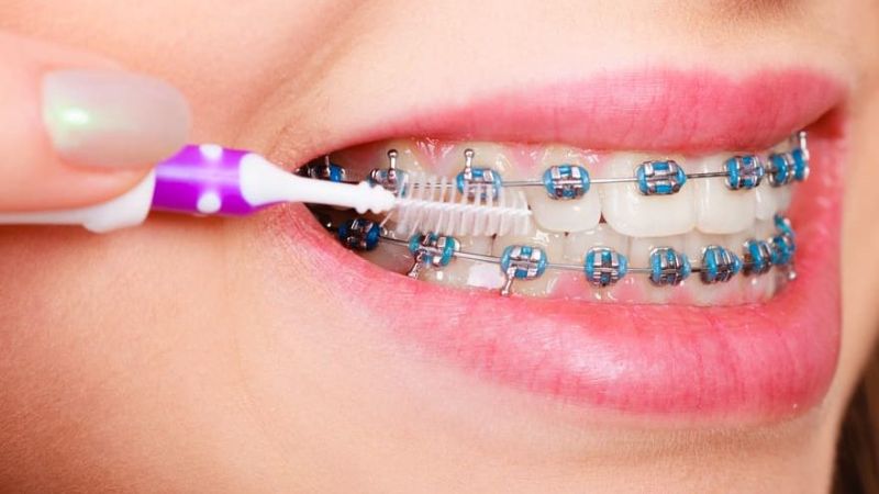Niềng răng có được ăn kem không? Cách ăn kem an toàn Ăn kem khi đang niềng răng rất khó vệ sinh