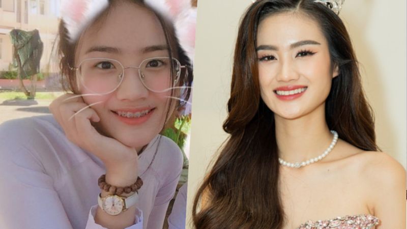 Niềng răng có được thi hoa hậu không? Loại chỉnh nha nào không ảnh hưởng Niềng răng có được thi hoa hậu không? Người niềng ra có thể thi hoa hậu bình thường