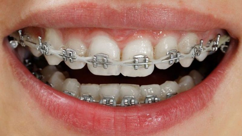 Niềng răng có được thi hoa hậu không? Loại chỉnh nha nào không ảnh hưởng Trường hợp niềng răng lộ mắc cài dễ bị trừ điểm hình ảnh trong cuộc thi hoa hậu