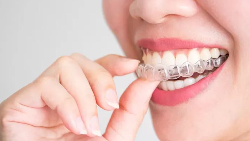 Niềng răng có được thi hoa hậu không? Loại chỉnh nha nào không ảnh hưởng Giai đoạn gần tháo niềng hoặc đeo niềng trong suốt rất thích hợp để bạn thi hoa hậu
