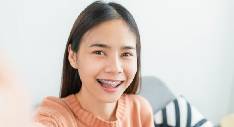 Niềng răng có giúp mặt thon gọn không? Bác sĩ giải đáp Niềng răng có giúp mặt thon gọn không? Câu trả lời là có.