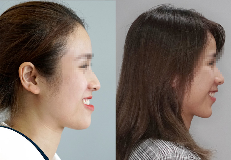 Niềng răng có giúp mặt thon gọn không? Bác sĩ giải đáp Gương mặt thay đổi rõ rệt sau niềng răng.