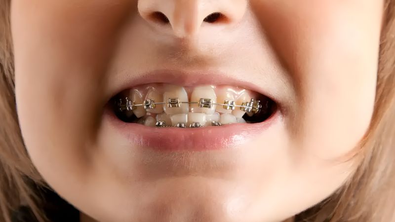 Niềng răng có hết móm không? Trường hợp niềng răng hết móm Tình trạng móm sẽ hết khi đáp ứng điều trị với các khí cụ chỉnh nha