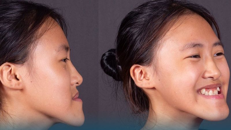 Niềng răng có hết móm không? Trường hợp niềng răng hết móm Với những trường hợp móm nặng do xương hàm cần kết hợp phẫu thuật