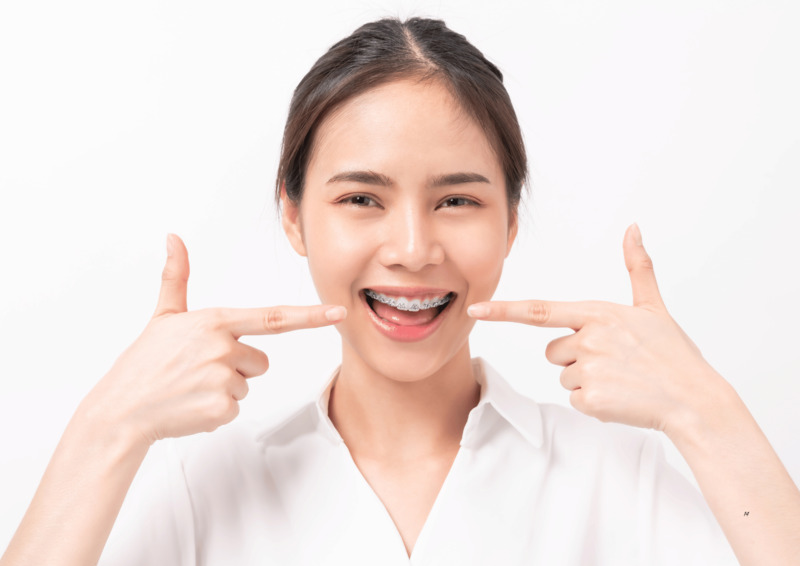 Niềng răng có làm mũi cao lên không? 3 Lý do bạn nên biết Niềng răng có làm mũi cao lên không? Không làm mũi cao lên mà do thị giác sau niềng răng.