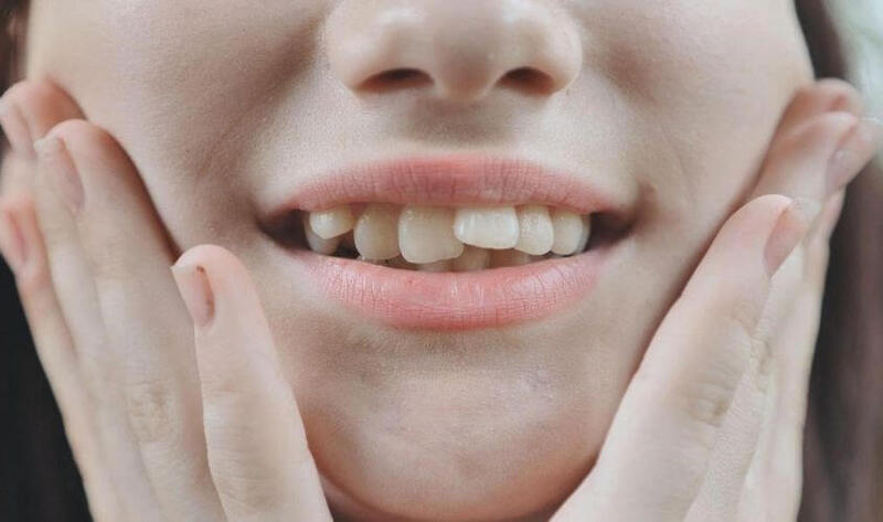 Niềng răng có làm mũi cao lên không? 3 Lý do bạn nên biết Người có răng cửa chìa sẽ có mũi cao hơn sau chỉnh nha.