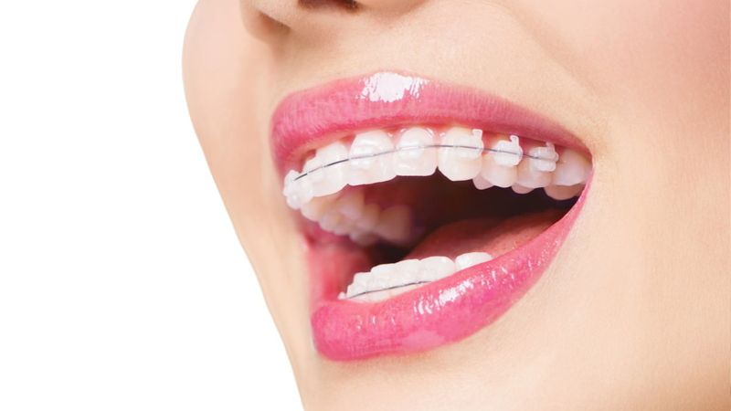Niềng răng có làm răng dài ra không? Cách phòng tránh Niềng răng có làm răng dài ra không?Niềng răng không làm răng dài ra