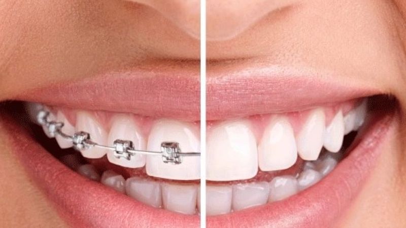 Niềng răng có làm răng dài ra không? Cách phòng tránh Hiện tượng răng dài ra xuất phát từ hiệu ứng thị giác