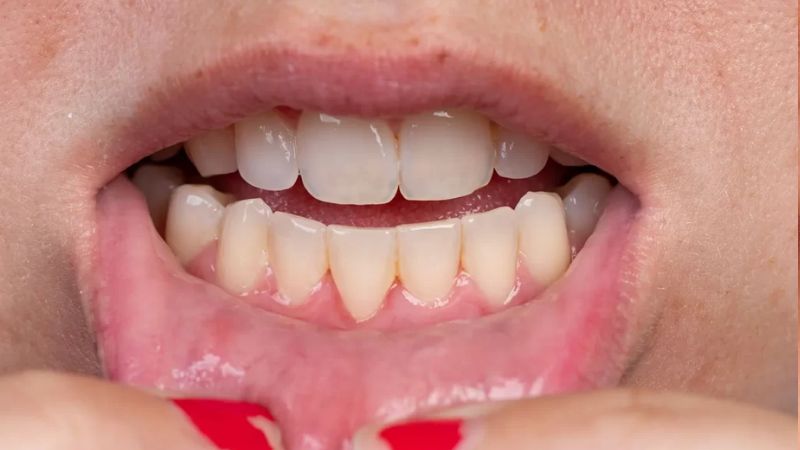 Niềng răng có làm răng dài ra không? Cách phòng tránh Niềng răng không gây tụt nướu nếu thực hiện đúng kỹ thuật ở nha khoa uy tín