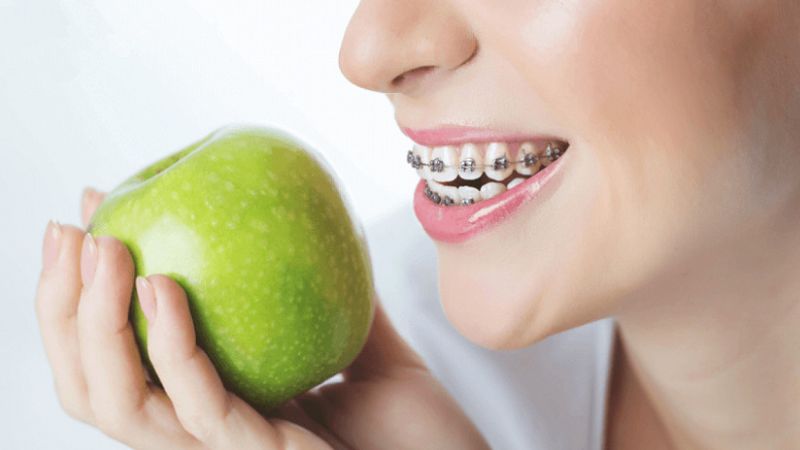 Niềng răng có làm răng dài ra không? Cách phòng tránh Chú ý đến chế độ ăn uống để tránh tình trạng răng trông dài ra