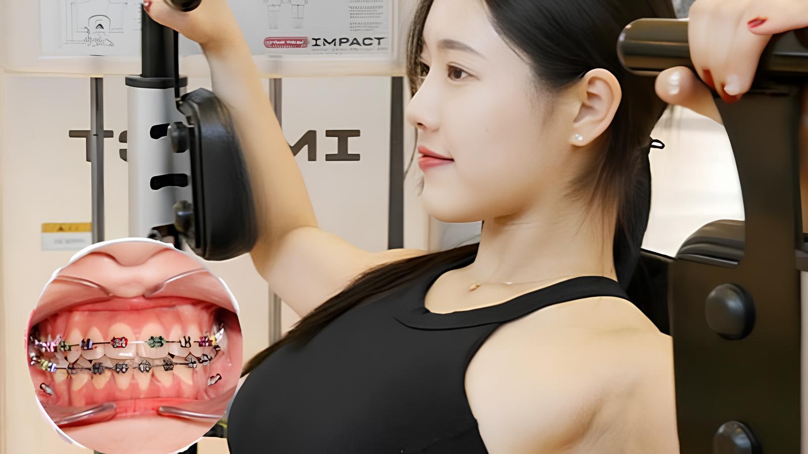 Niềng răng có tập gym được không? Hướng dẫn an toàn cho gymer đang chỉnh nha Niềng răng có tập gym được không? Người niềng răng có thể tập gym an toàn
