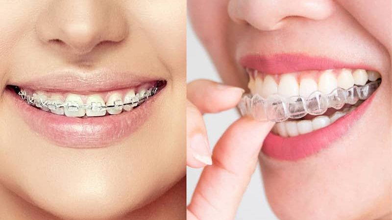 Niềng răng có tháo ra được không? Trường hợp được phép tháo niềng Niềng răng có tháo ra được không? Người đang niềng răng nếu được bác sĩ nha khoa cho phép có thể tháo niềng