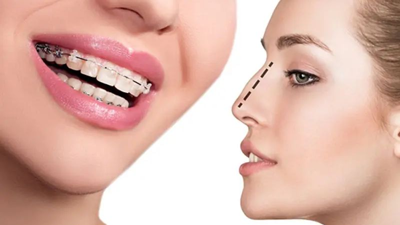 Niềng răng có tháo ra được không? Trường hợp được phép tháo niềng Những người đã hoàn tất lộ trình chỉnh nha đủ điều kiện để tháo niềng