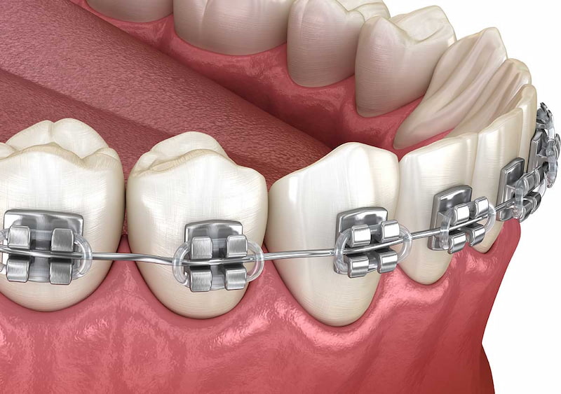 Niềng răng hàm dưới giá bao nhiêu? Có rẻ hơn niềng hai hàm? Giá niềng hàm dưới không cố định cho mọi người mà có sự khác biệt