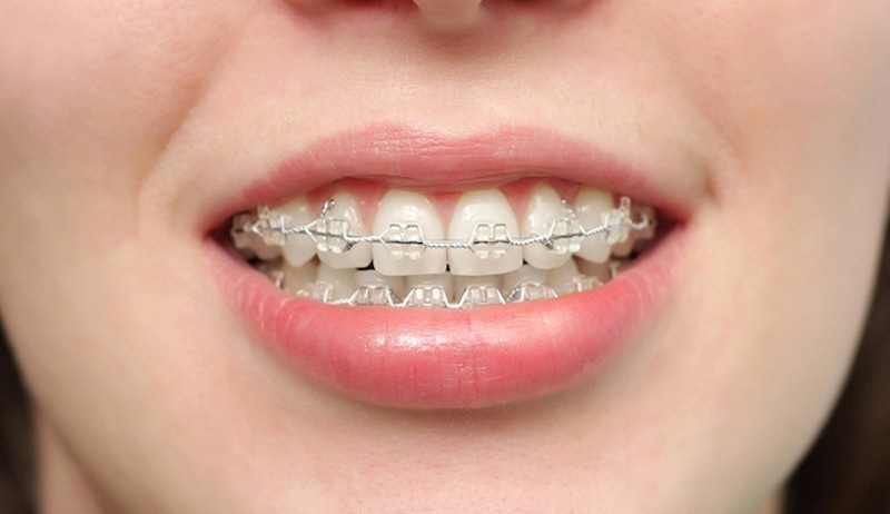 Giải đáp chi tiết: Niềng răng mắc cài pha lê có tốt không Mắc cài pha lê thiết kế trong suốt hoặc có màu tương tự màu răng