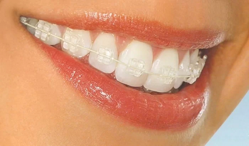 Giải đáp chi tiết: Niềng răng mắc cài pha lê có tốt không Bề mặt mắc cài pha lê chế tác láng mịn, giảm ma sát với môi, má và nướu