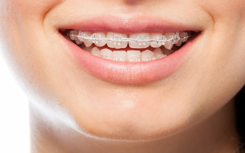 Giải đáp chi tiết: Niềng răng mắc cài pha lê có tốt không Nên chỉnh nha mắc cài pha lê vì vấn đảm bảo hiệu quả và tính thẩm mỹ