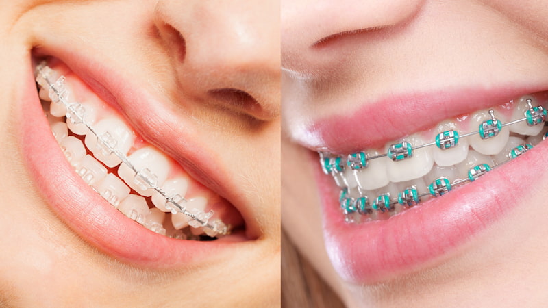 Niềng răng mắc cài sứ mất bao lâu? Cách rút ngắn lộ trình Thời gian niềng mắc cài sứ lâu hơn vài tháng so với mắc cài kim loại thường