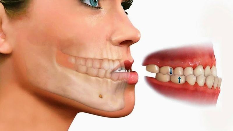 Niềng răng móm giá bao nhiêu? Chi tiết giá từng phương pháp Chi phí để niềng răng móm có thể lên tới 128.000.000 VNĐ