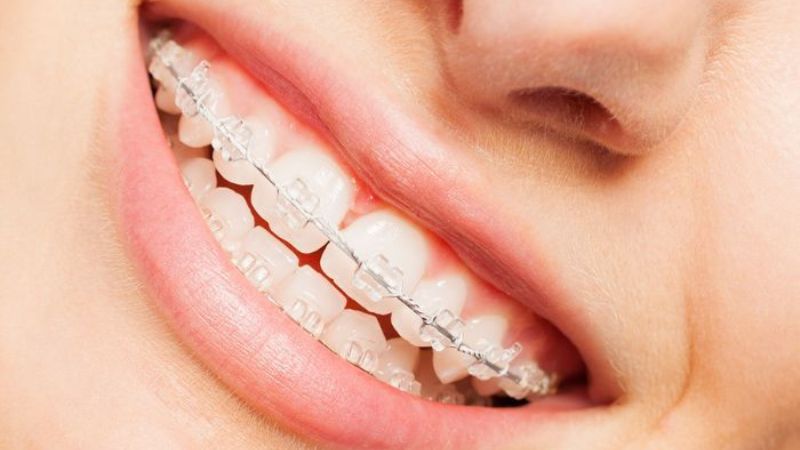 Niềng răng móm giá bao nhiêu? Chi tiết giá từng phương pháp Một số dịch vụ phát sinh cũng khiến mức giá niềng răng móm tăng cao