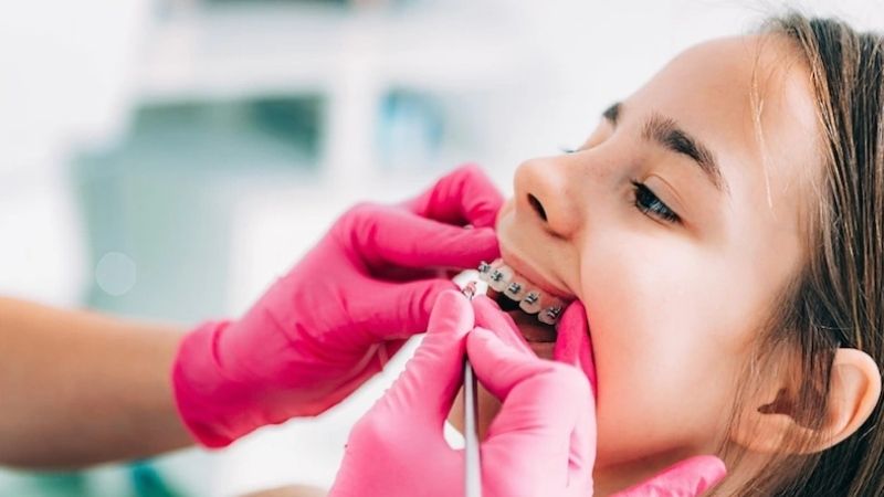 Niềng răng xong bị hô nguyên nhân do đâu? Cách cải thiện Nếu niềng răng xong bị hô nặng bác sĩ cần xây dựng lại phác đồ chỉnh nha