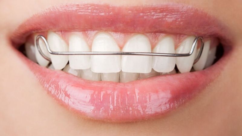 Quy trình niềng răng thưa: 6 bước chuẩn y khoa hiệu quả Chú ý đeo hàm duy trì theo chỉ định nhằm hạn chế nguy cơ răng dịch chuyển trở lại