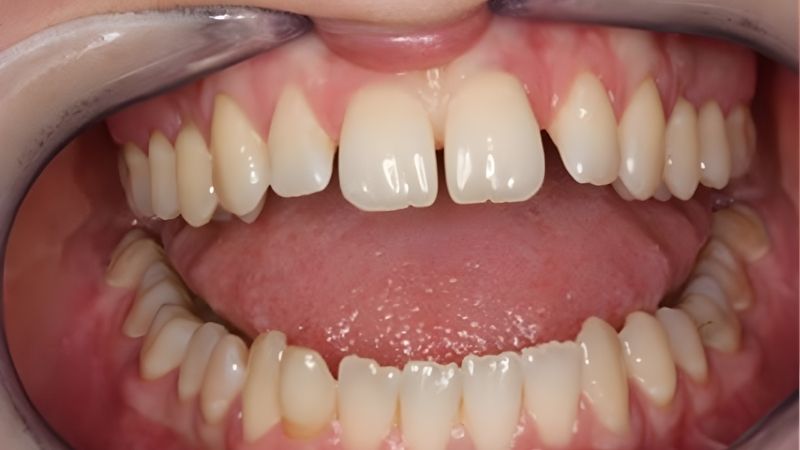 Răng bị thưa sau khi niềng: Nguyên nhân và giải pháp khắc phục Răng bị thưa sau khi niềng có thể do cấu trúc răng và xương hàm chưa ổn định