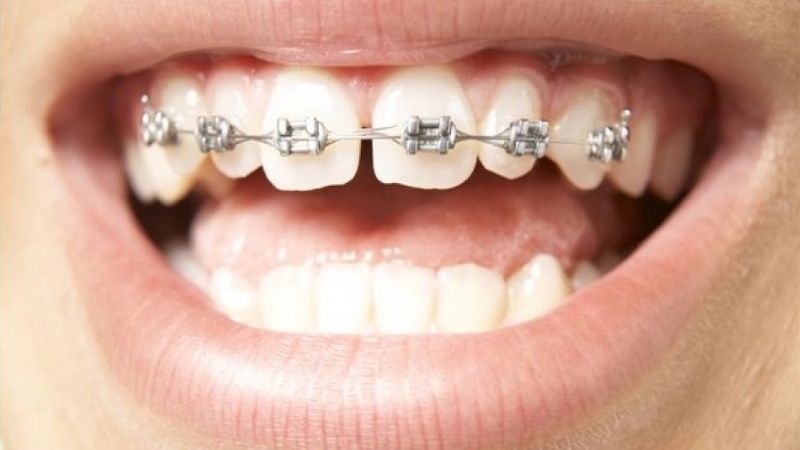 Răng bị thưa sau khi niềng: Nguyên nhân và giải pháp khắc phục Đối với răng thưa nặng, bác sĩ cần xây dựng kế hoạch điều trị chi tiết