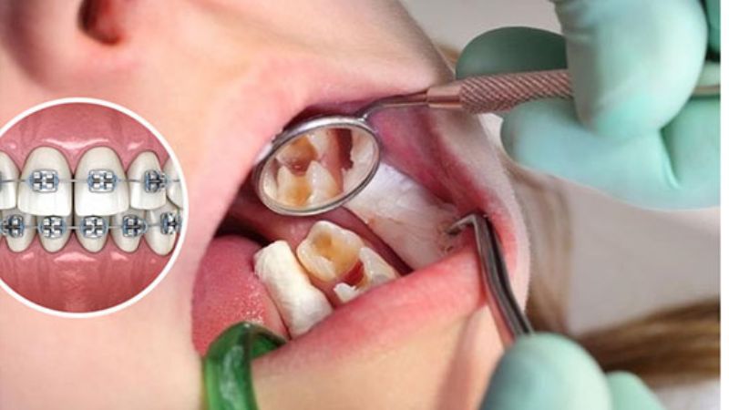 Răng đã lấy tủy có niềng được không? 3 Điều kiện bắt buộc cần biết Răng đã lấy tủy có niềng được không?Răng đã lấy tủy vẫn niềng răng được khi đủ điều kiện