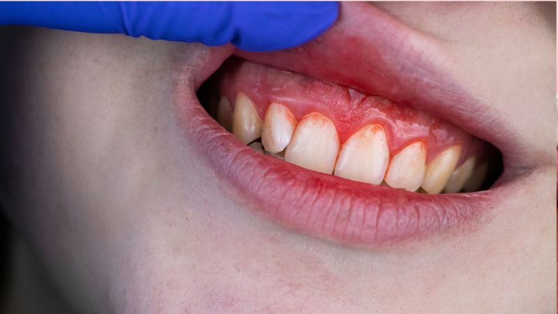 Răng đã lấy tủy có niềng được không? 3 Điều kiện bắt buộc cần biết Răng có viêm quanh chóp không thể thực hiện niềng