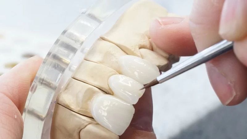 Răng sứ trắng đục là gì? Mức độ ảnh hưởng và cách khắc phục Lựa chọn các loại răng làm từ sứ cao cấp để tránh tình trạng màu răng trắng đục