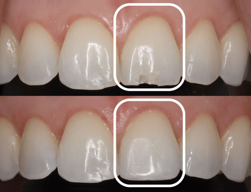 Răng trám có niềng được không? 5 Lưu ý khi niềng răng Răng trám nhỏ là nhóm răng trám niềng an toàn nhất.