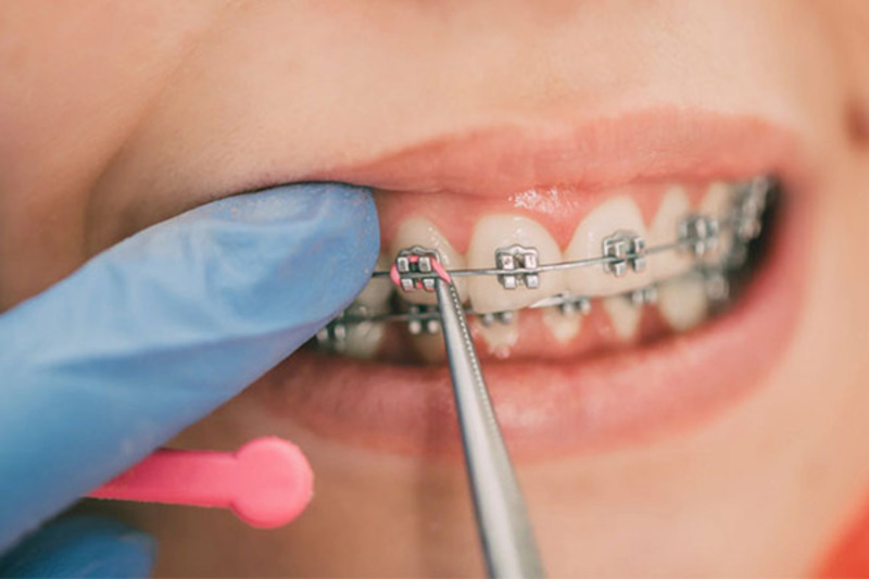 Răng trám có niềng được không? 5 Lưu ý khi niềng răng Răng trám hoàn toàn có thể niềng răng được.