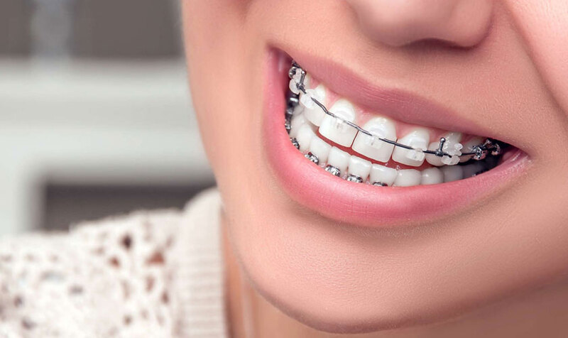 Răng trám có niềng được không? 5 Lưu ý khi niềng răng Cần xử lý răng trám viêm tủy trước khi niềng răng.