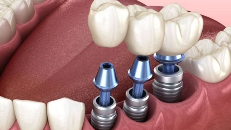 Review trồng răng Implant: Kinh nghiệm thực tế từ khách hàng và nha sĩ Review trồng răng implant từ người bệnh cho thấy phương pháp không gây đau