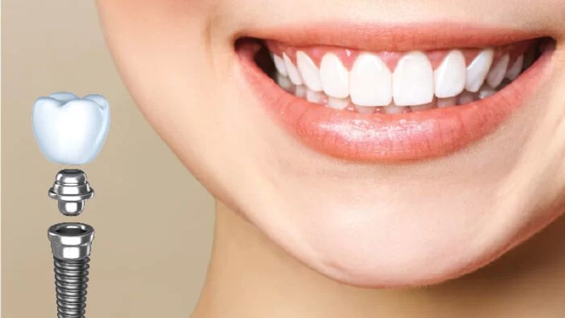 Review trồng răng Implant: Kinh nghiệm thực tế từ khách hàng và nha sĩ Phần lớn người bệnh đạt tình trạng răng miệng ổn định sau phục hình răng mất 1 - 3 tháng